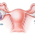 Laparoscopic ovarian cystectomy services in Kenya Laparoscopic ovarian cystectomy is a minimally invasive surgical procedure used to remove ovarian cysts. It involves making small incisions in the abdomen through which a laparoscope (a thin, lighted tube with a camera) and surgical instruments are inserted. The surgeon then locates and removes the cyst from the ovary. Elevate your ovarian health with our laparoscopic ovarian cystectomy service. Using advanced laparoscopic techniques, we delicately remove ovarian cysts, offering relief from discomfort and safeguarding your reproductive potential. This procedure is preferred over traditional open surgery for ovarian cyst removal because it typically results in less pain, faster recovery times, and reduced risk of complications such as infection and scarring. Contact us and let the serenity of expert care take possession of your well-being. Your path to a fulfilling and healthy life begins with us. Reach out today and experience the difference. We are located at Thika town, Kwame Nkurumah Rd, Pushpa Plaza, (Opp Unaitas bank) 4th floor Suite E2. Contact us on (+254) 0796 633428 Email: info@saumed.co.ke