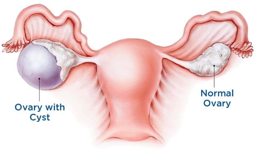 Laparoscopic ovarian cystectomy services in Kenya Laparoscopic ovarian cystectomy is a minimally invasive surgical procedure used to remove ovarian cysts. It involves making small incisions in the abdomen through which a laparoscope (a thin, lighted tube with a camera) and surgical instruments are inserted. The surgeon then locates and removes the cyst from the ovary. Elevate your ovarian health with our laparoscopic ovarian cystectomy service. Using advanced laparoscopic techniques, we delicately remove ovarian cysts, offering relief from discomfort and safeguarding your reproductive potential. This procedure is preferred over traditional open surgery for ovarian cyst removal because it typically results in less pain, faster recovery times, and reduced risk of complications such as infection and scarring. Contact us and let the serenity of expert care take possession of your well-being. Your path to a fulfilling and healthy life begins with us. Reach out today and experience the difference. We are located at Thika town, Kwame Nkurumah Rd, Pushpa Plaza, (Opp Unaitas bank) 4th floor Suite E2. Contact us on (+254) 0796 633428 Email: info@saumed.co.ke