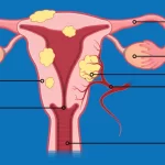 Laparoscopic fibroid removal or laparoscopic myomectomy services and procedure in Kenya Unveiling our laparoscopic myomectomy service – a state-of-the-art procedure designed to liberate you from the discomfort of uterine fibroids. With minimal incisions and advanced technology, we target and remove fibroids, preserving your reproductive health and well-being. Laparoscopic fibroid removal, also known as laparoscopic myomectomy, is a minimally invasive surgical procedure used to remove uterine fibroids. It involves making small incisions in the abdomen through which a laparoscope (a thin, lighted tube with a camera) and surgical instruments are inserted. This approach offers several advantages over traditional open surgery, including quicker recovery times, less pain, and smaller scars. Laparoscopic fibroid removal services in Kenya During the procedure, the surgeon uses the laparoscope to locate and remove the fibroids from the uterus. The size and number of fibroids, as well as their location within the uterus, can influence whether laparoscopic myomectomy is suitable for a particular patient. Recovery typically involves a shorter hospital stay compared to open surgery, and most women can resume normal activities within a few weeks. As with any surgical procedure, there are risks and potential complications, so it's important to discuss these with your healthcare provider to determine the best treatment approach for you. Benefits of Laparoscopic fibroid removal or laparoscopic myomectomy Laparoscopic fibroid removal, or laparoscopic myomectomy, offers several benefits compared to traditional open surgery: 1. Minimally Invasive: The procedure is performed through small incisions (usually less than 1 cm), resulting in reduced trauma to surrounding tissues and less post-operative pain. 2. Faster Recovery: Patients typically experience a quicker recovery time compared to open surgery. They may return to normal activities within a few weeks. 3. Reduced Blood Loss: Laparoscopic techniques can minimize blood loss during surgery, reducing the need for blood transfusions. 4. Preservation of Uterus: For women who wish to preserve their uterus, laparoscopic myomectomy allows for the removal of fibroids while leaving the uterus intact, which is beneficial for future fertility and menstrual health. 5. Lower Risk of Infection: Smaller incisions lower the risk of surgical site infections and other post-operative complications. 6. Less Scarring: The incisions made during laparoscopic surgery are much smaller than those in traditional surgery, resulting in smaller scars and potentially improved cosmetic outcomes. 7. Shorter Hospital Stay: Many patients undergoing laparoscopic myomectomy can go home the same day or after an overnight stay, compared to a longer hospital stay required for open surgery. 8. Improved Visualization: The laparoscope provides magnified, high-definition views of the surgical area, allowing for precise removal of fibroids. Overall, laparoscopic fibroid removal offers a less invasive alternative to open surgery, with fewer complications and a faster recovery time, making it a preferred option for many women. Contact us and let the serenity of expert care take possession of your well-being. Your path to a fulfilling and healthy life begins with us. Reach out today and experience the difference. Location: Thika town, Kwame Nkurumah Rd, Pushpa Plaza, (Opp Unaitas bank) 4th floor Suite E2. Email: info@saumed.co.ke Phone: 0796 633428