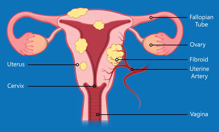 Laparoscopic fibroid removal or laparoscopic myomectomy services and procedure in Kenya Unveiling our laparoscopic myomectomy service – a state-of-the-art procedure designed to liberate you from the discomfort of uterine fibroids. With minimal incisions and advanced technology, we target and remove fibroids, preserving your reproductive health and well-being. Laparoscopic fibroid removal, also known as laparoscopic myomectomy, is a minimally invasive surgical procedure used to remove uterine fibroids. It involves making small incisions in the abdomen through which a laparoscope (a thin, lighted tube with a camera) and surgical instruments are inserted. This approach offers several advantages over traditional open surgery, including quicker recovery times, less pain, and smaller scars. Laparoscopic fibroid removal services in Kenya During the procedure, the surgeon uses the laparoscope to locate and remove the fibroids from the uterus. The size and number of fibroids, as well as their location within the uterus, can influence whether laparoscopic myomectomy is suitable for a particular patient. Recovery typically involves a shorter hospital stay compared to open surgery, and most women can resume normal activities within a few weeks. As with any surgical procedure, there are risks and potential complications, so it's important to discuss these with your healthcare provider to determine the best treatment approach for you. Benefits of Laparoscopic fibroid removal or laparoscopic myomectomy Laparoscopic fibroid removal, or laparoscopic myomectomy, offers several benefits compared to traditional open surgery: 1. Minimally Invasive: The procedure is performed through small incisions (usually less than 1 cm), resulting in reduced trauma to surrounding tissues and less post-operative pain. 2. Faster Recovery: Patients typically experience a quicker recovery time compared to open surgery. They may return to normal activities within a few weeks. 3. Reduced Blood Loss: Laparoscopic techniques can minimize blood loss during surgery, reducing the need for blood transfusions. 4. Preservation of Uterus: For women who wish to preserve their uterus, laparoscopic myomectomy allows for the removal of fibroids while leaving the uterus intact, which is beneficial for future fertility and menstrual health. 5. Lower Risk of Infection: Smaller incisions lower the risk of surgical site infections and other post-operative complications. 6. Less Scarring: The incisions made during laparoscopic surgery are much smaller than those in traditional surgery, resulting in smaller scars and potentially improved cosmetic outcomes. 7. Shorter Hospital Stay: Many patients undergoing laparoscopic myomectomy can go home the same day or after an overnight stay, compared to a longer hospital stay required for open surgery. 8. Improved Visualization: The laparoscope provides magnified, high-definition views of the surgical area, allowing for precise removal of fibroids. Overall, laparoscopic fibroid removal offers a less invasive alternative to open surgery, with fewer complications and a faster recovery time, making it a preferred option for many women. Contact us and let the serenity of expert care take possession of your well-being. Your path to a fulfilling and healthy life begins with us. Reach out today and experience the difference. Location: Thika town, Kwame Nkurumah Rd, Pushpa Plaza, (Opp Unaitas bank) 4th floor Suite E2. Email: info@saumed.co.ke Phone: 0796 633428