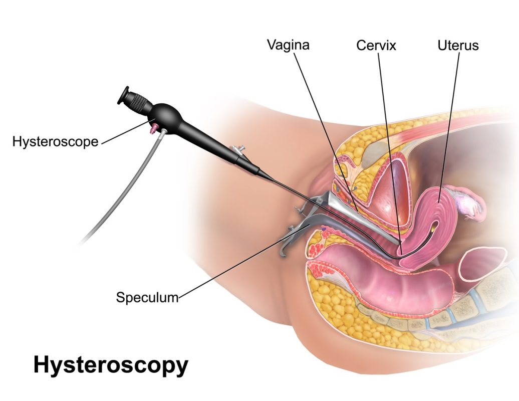 Hysteroscopy A Precise, Minimally Invasive Approach to Diagnosing and Treating Uterine Conditions